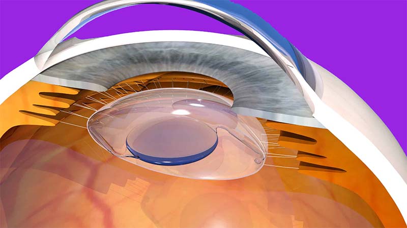 Multifocal Lens Treatment in Turkey